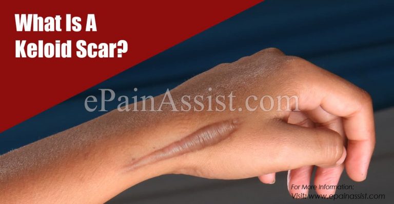 What Is A Keloid Scar & How To Get Rid Of It?
