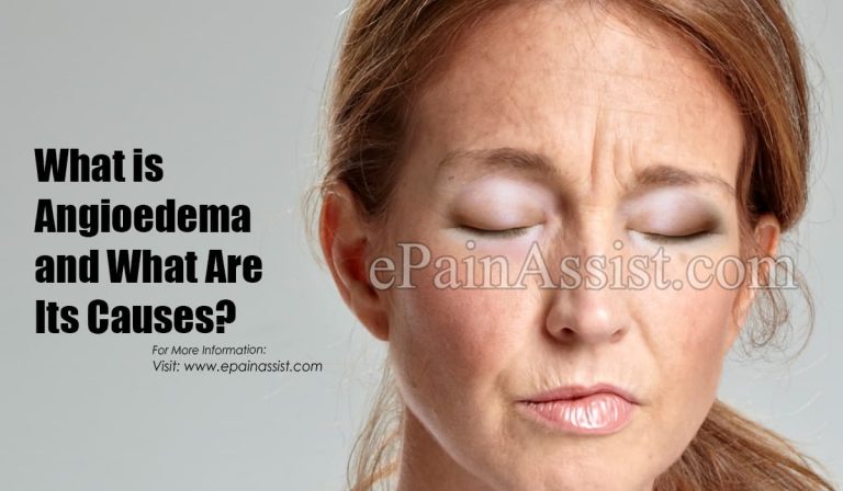 What is Angioedema: Causes, Symptoms, Types, Treatment, Who is at Risk, Diagnosis