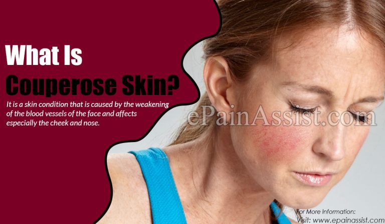 What Is Couperose Skin: Causes, Symptoms, Treatments