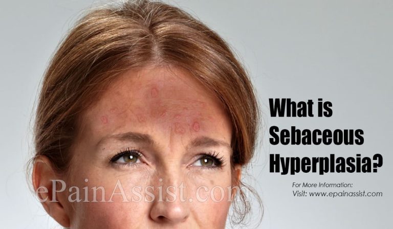 What Causes Sebaceous Hyperplasia And How To Get Rid Of Them?