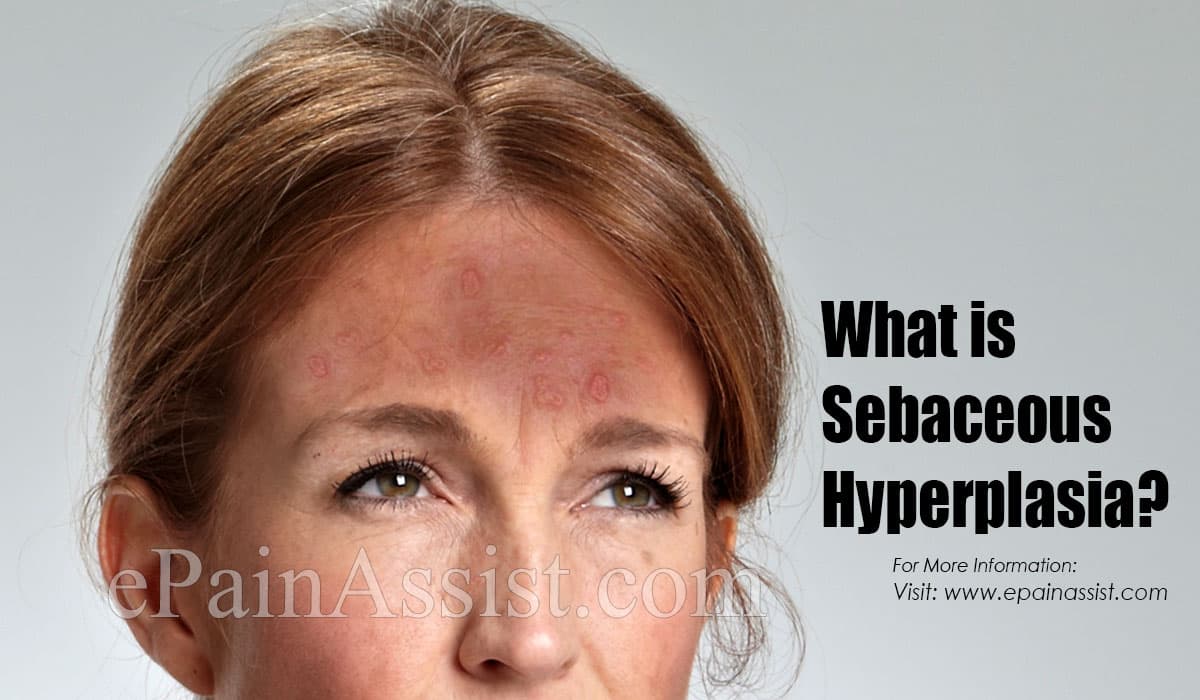 What is Sebaceous Hyperplasia?