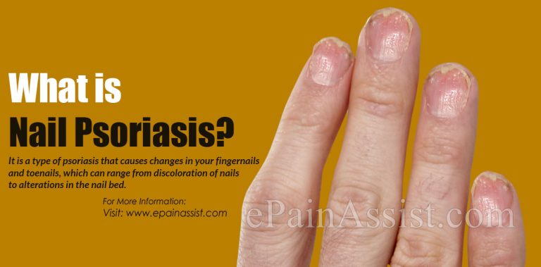 Nail Psoriasis: Symptoms, Treatments & Home Remedies