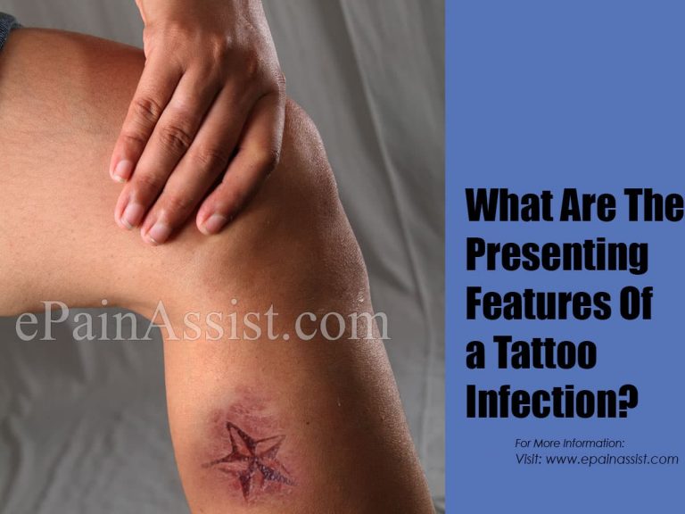 What Are The Presenting Features Of A Tattoo Infection & How To Manage It?