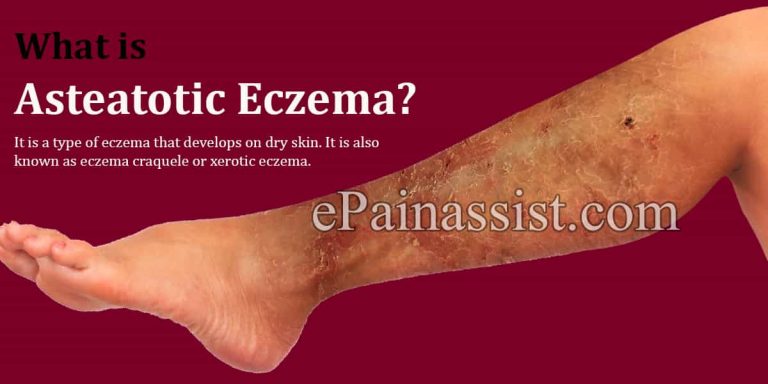 What is Asteatotic Eczema: Causes, Risk Factors, Symptoms, Treatment, Home Remedies, Prevention