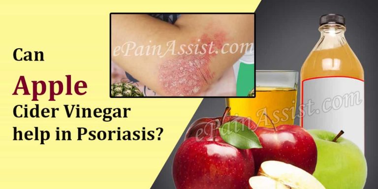 Can Apple Cider Vinegar Help in Psoriasis?