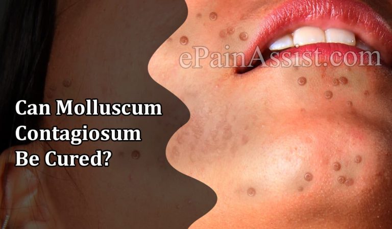 Can Molluscum Contagiosum Be Cured?