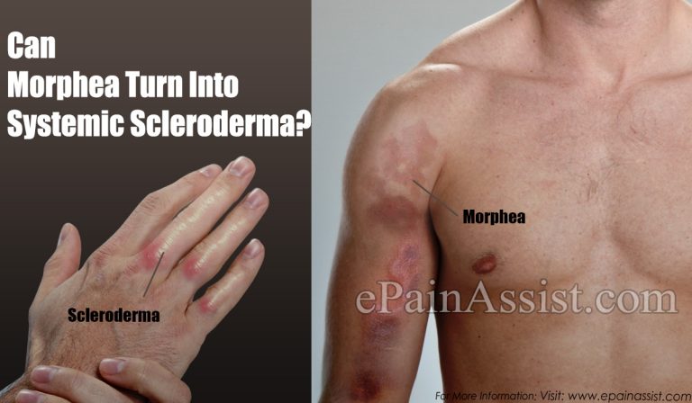 Can Morphea Turn Into Systemic Scleroderma?