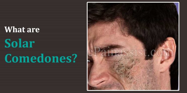 Causes of Solar Comedones & Treatments to Get Rid of It