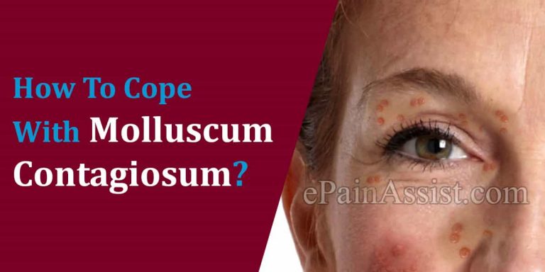How To Cope With Molluscum Contagiosum?