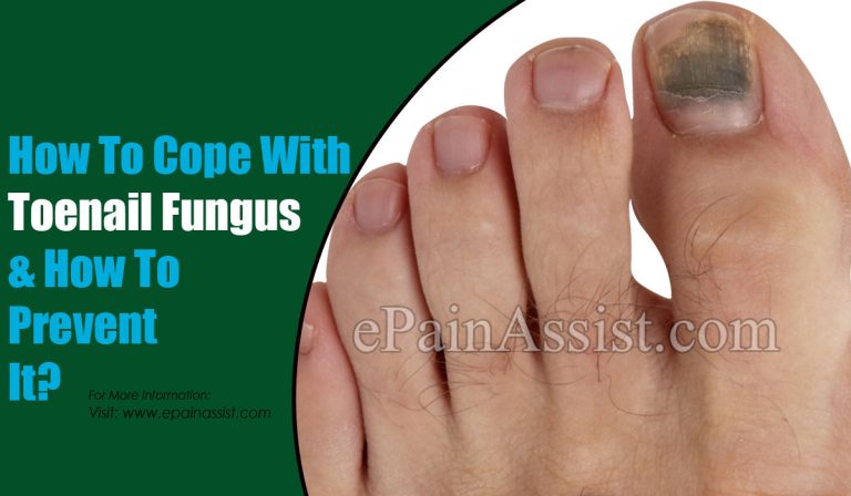 How To Cope With Toenail Fungus & How To Prevent It?