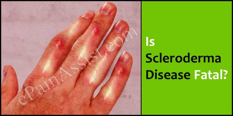 Is Scleroderma Disease Fatal?