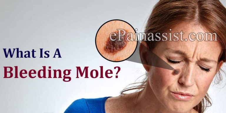 What Is A Bleeding Mole & What Can Be Done About It?