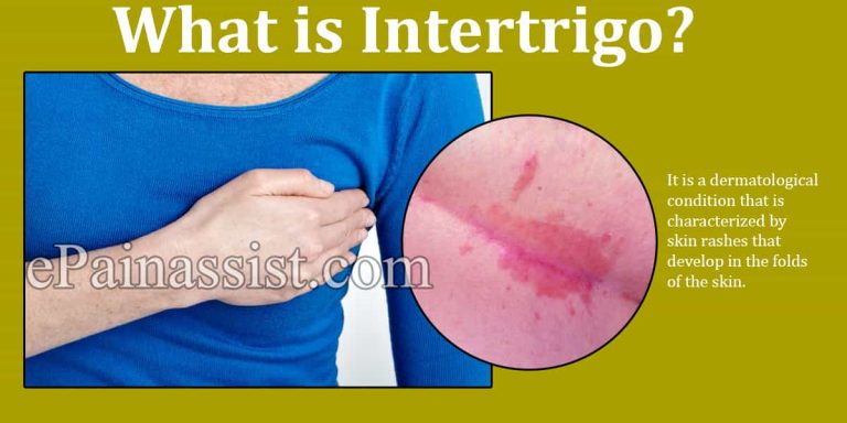 What is Intertrigo: Causes, Symptoms, Treatments, Prevention