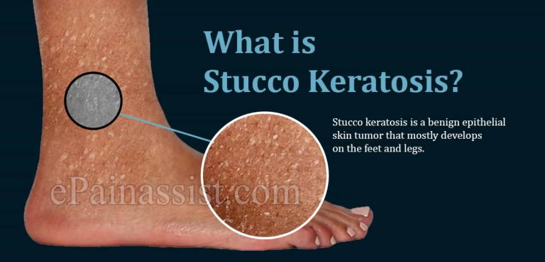 What is Stucco Keratosis & Is it Harmful?|Causes and Treatment of Stucco Keratosis
