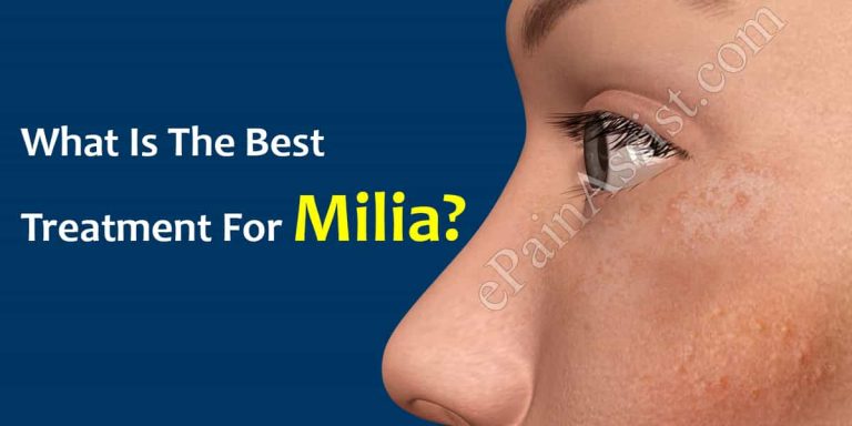 What Is The Best Treatment For Milia?