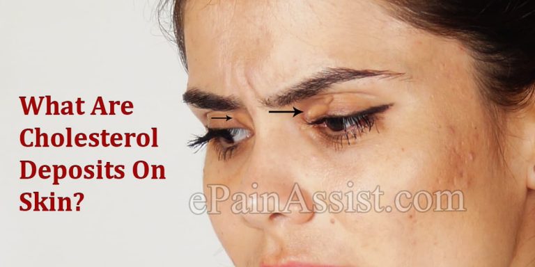 Who Gets Cholesterol Deposits On Skin, Know its Causes, Symptoms, Treatment, Diet, Lifestyle Modifications