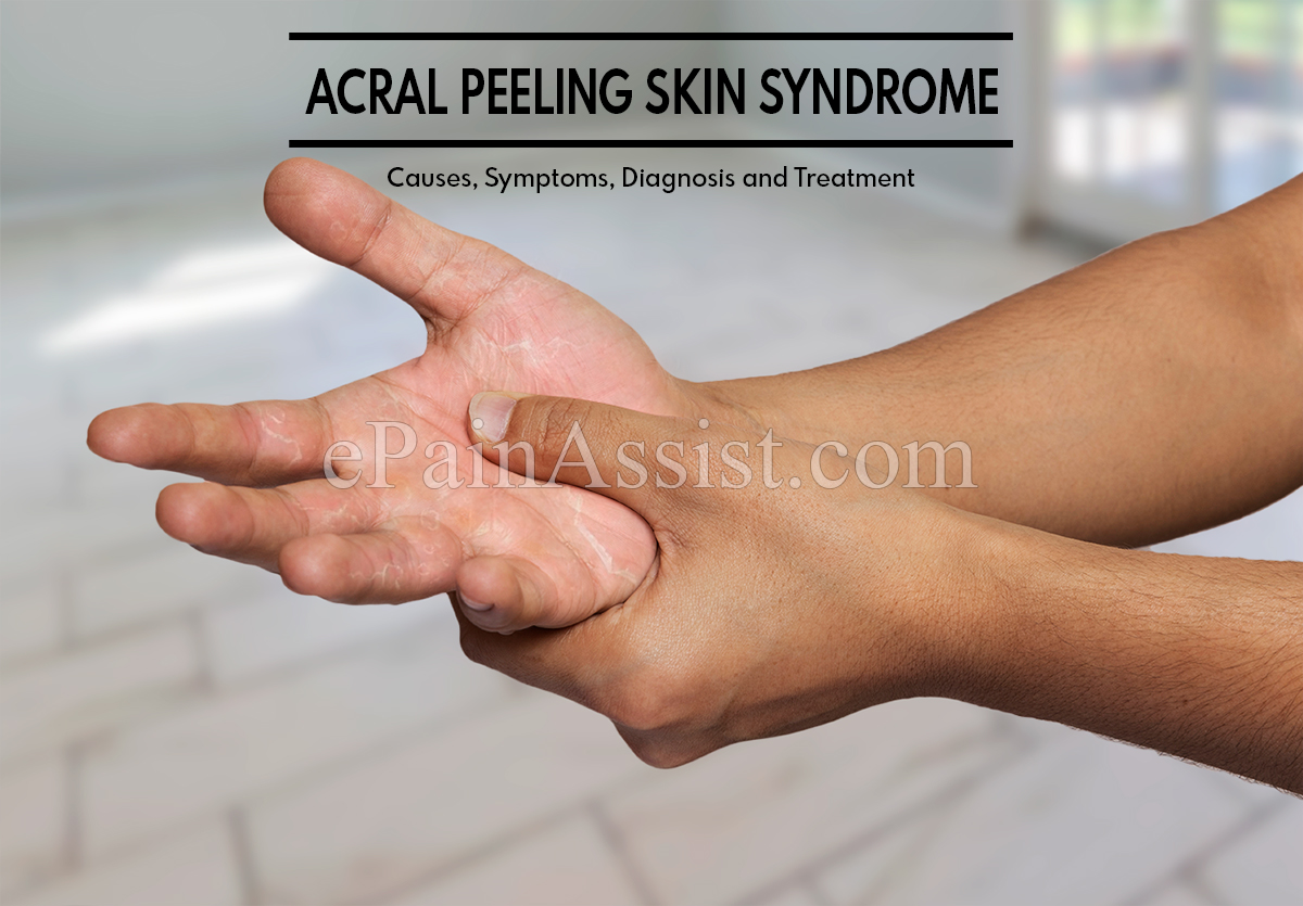 What is Acral peeling Skin Syndrome? What is Acral peeling Skin Syndrome?