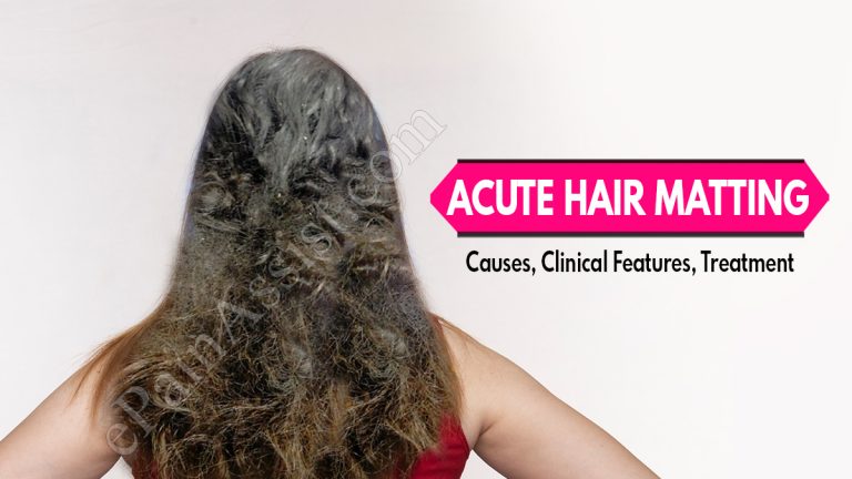 Acute Hair Matting: Causes, Clinical Features, Treatment