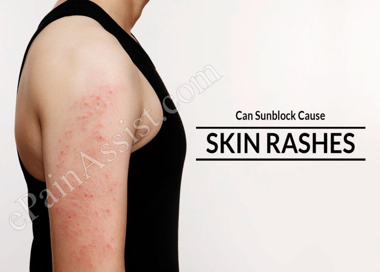 Can Sunblock Cause Skin Rashes; And If Yes, Then How To Prevent It?