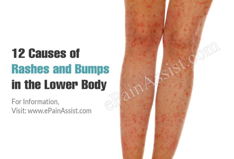 12 Causes of Rashes and Bumps in the Lower Body