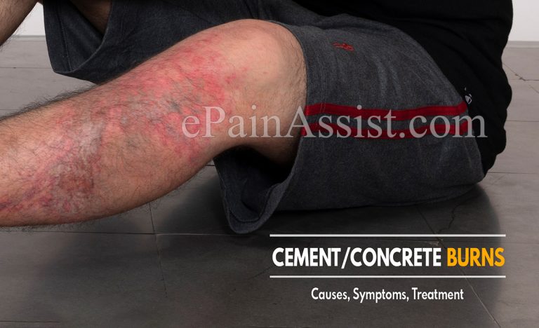 Cement/Concrete Burns : Causes, Symptoms, Treatment, Prevention