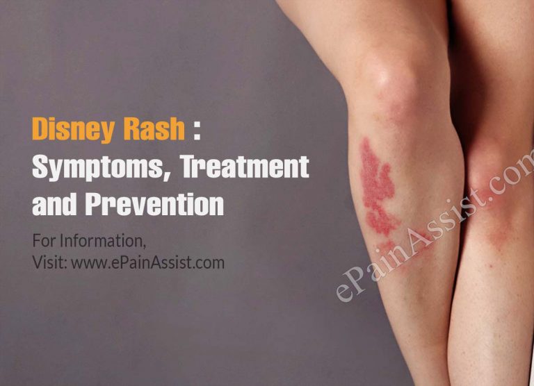 Disney Rash: Symptoms, Treatment and Prevention