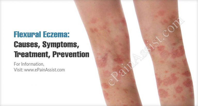 Flexural Eczema: Causes, Symptoms, Treatment, Prevention