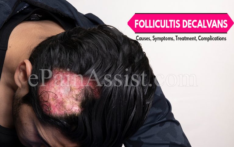 Folliculitis Decalvans: Causes, Symptoms, Treatment, Complications