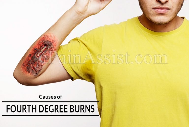 Fourth Degree Burns: Causes, Symptoms, First-Aid and Treatment