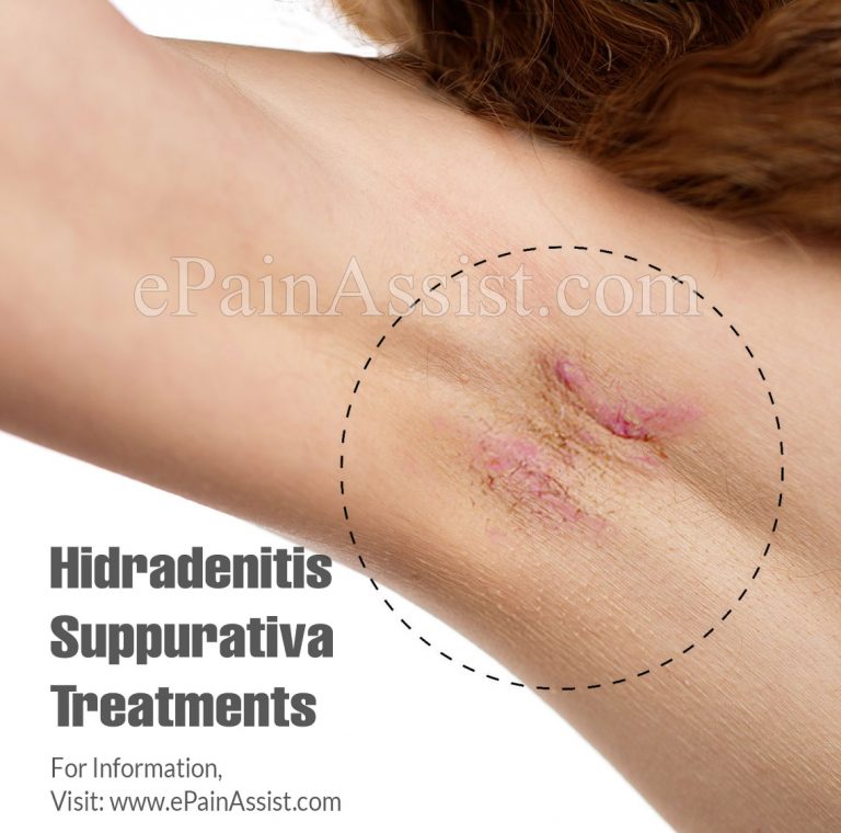 Hidradenitis Suppurativa Treatments: Topical, Antibiotics, Pain Medications, Corticosteroids, Hormone Therapy, Biologics, Retinoids, Surgery