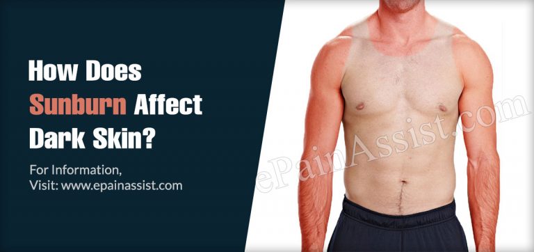How Does Sunburn Affect Dark Skin?