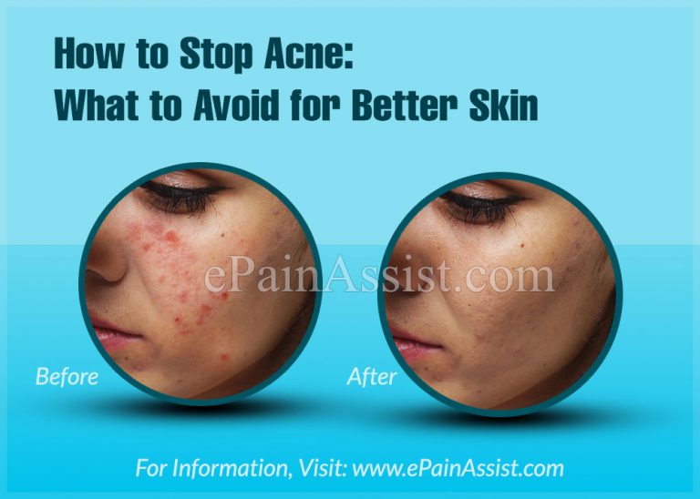 How to Stop Acne: What to Avoid for Better Skin