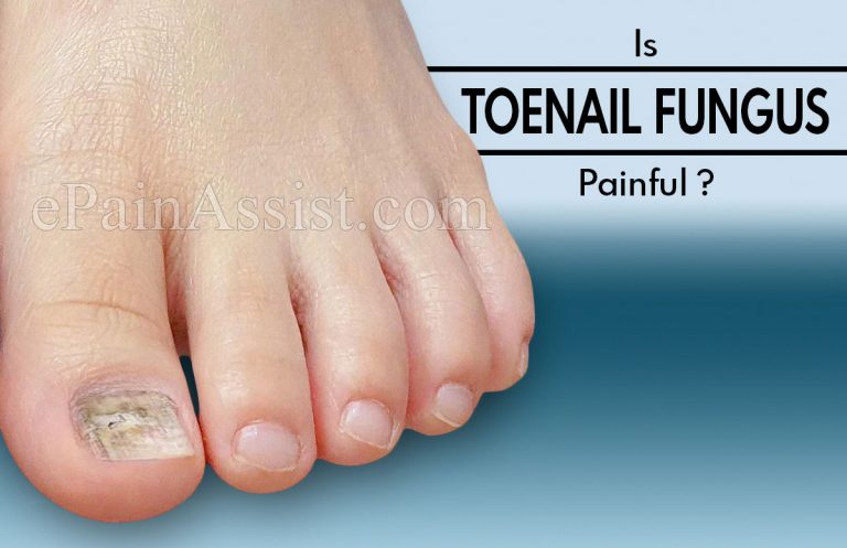 Is Toenail Fungus Painful And Is It Curable?
