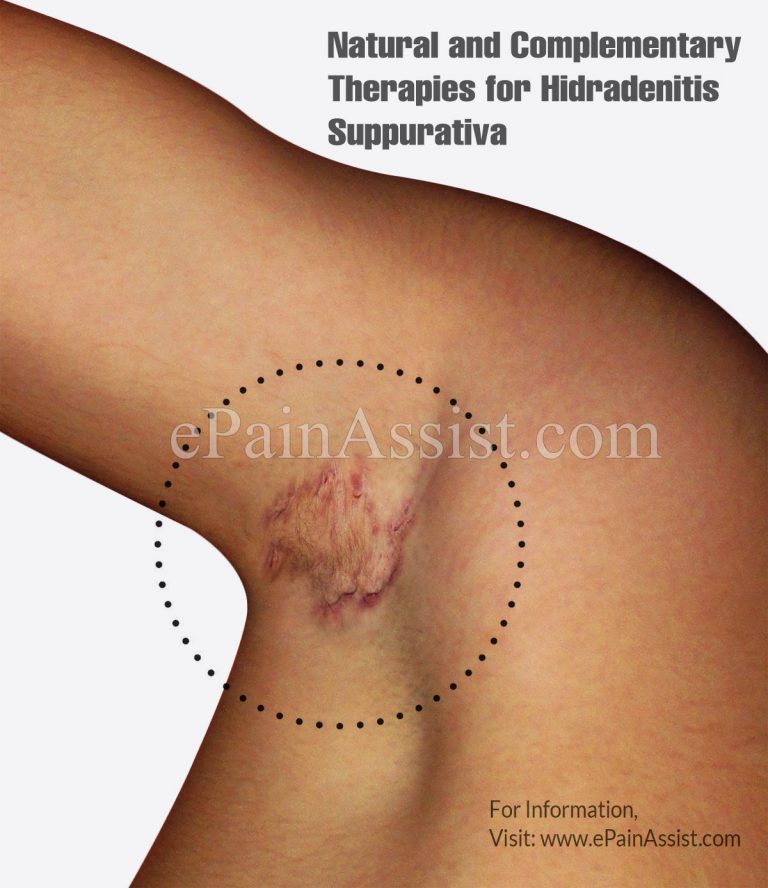 Natural and Complementary Therapies for Hidradenitis Suppurativa