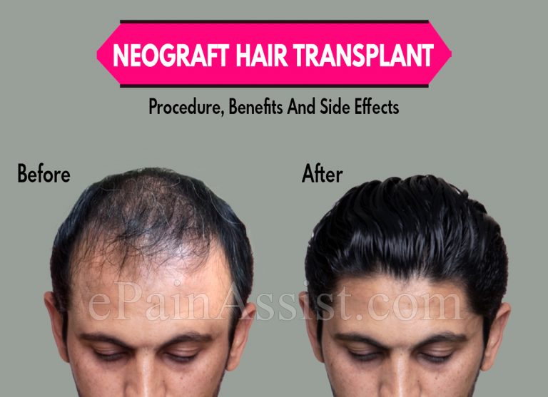 Neograft Hair Transplant: Procedure, Benefits And Side Effects