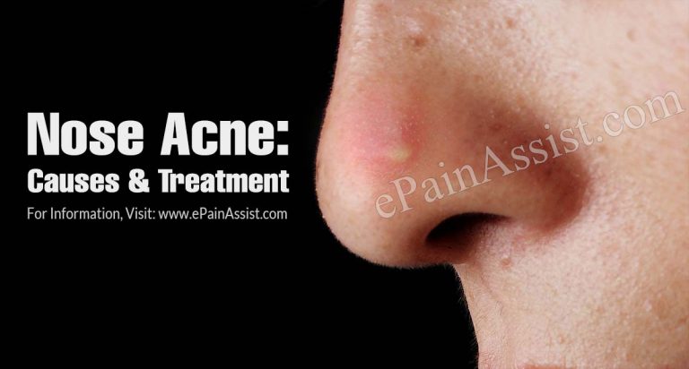 Nose Acne: Causes & Treatment