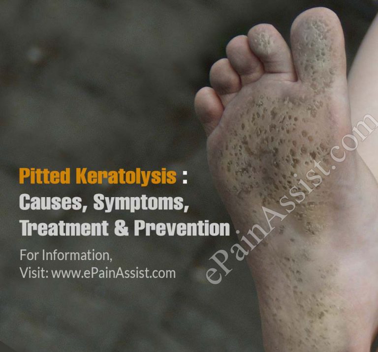 Pitted Keratolysis: Causes, Symptoms, Treatment and Prevention