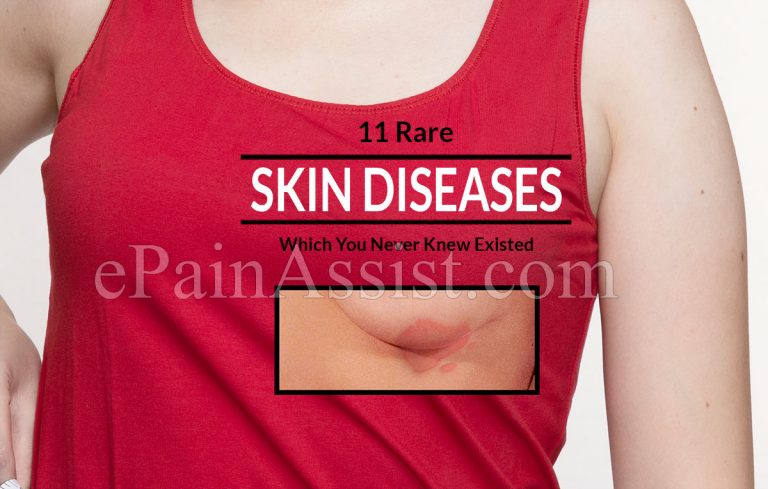 11 Rare Skin Diseases Which You Never Knew Existed