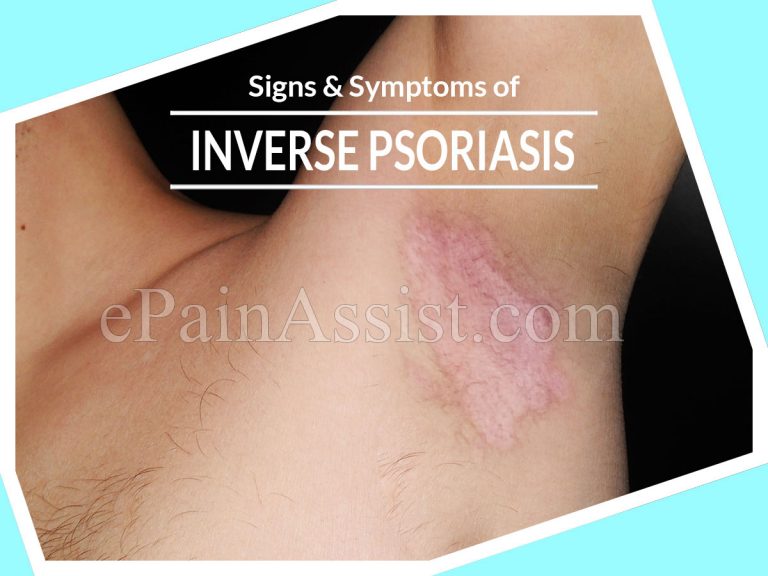 Recognizing the Signs & Symptoms of Inverse Psoriasis or Jock Itch