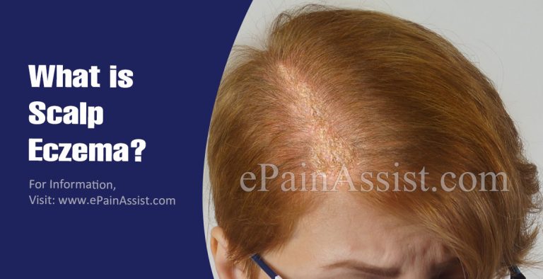 Scalp Eczema: Types, Causes, Symptoms and Treatment