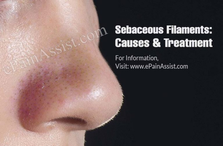 Sebaceous Filaments: Causes & Treatment
