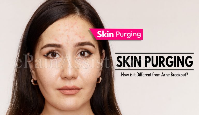 Skin Purging: Causes, Treatment and How is it Different from Acne Breakout?