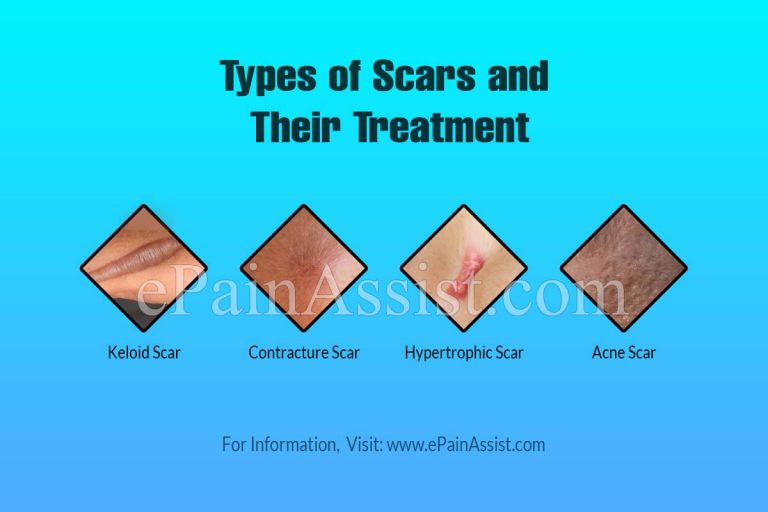 Types of Scars and Their Treatments