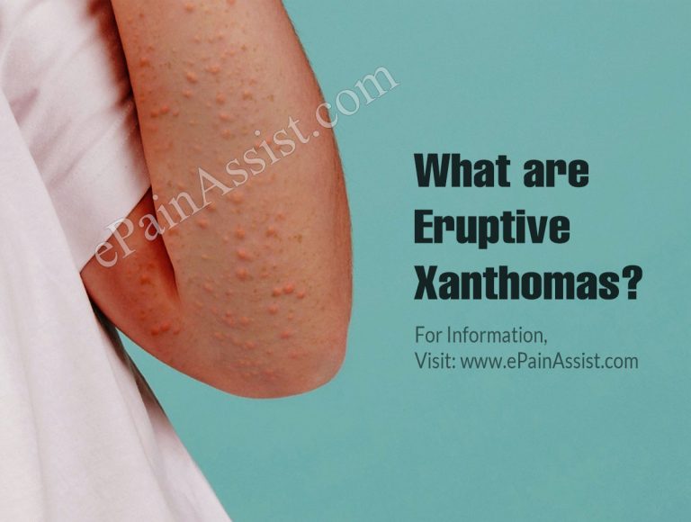What are Eruptive Xanthomas & How Is It Treated? Causes, Symptoms and Prognosis of Eruptive Xanthomas