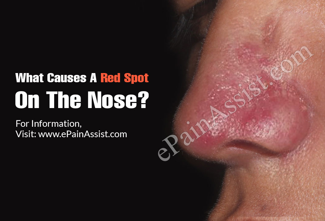 What Causes A Red Spot On The Nose?