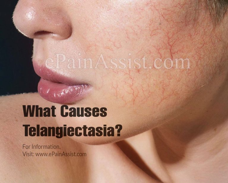 Telangiectasia: Causes, Symptoms, Treatment, Prognosis, Risk Factors, Diagnosis