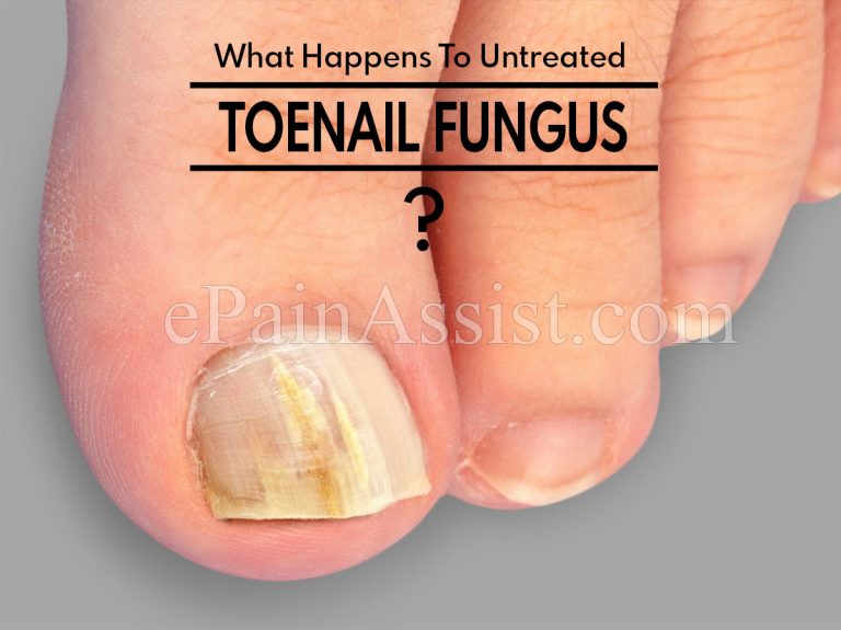 What Happens To Untreated Toenail Fungus?
