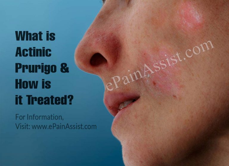 What is Actinic Prurigo & How is it Treated?