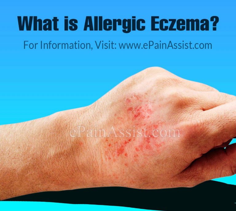 What is Allergic Eczema, Know its Symptoms, Treatment, Prognosis