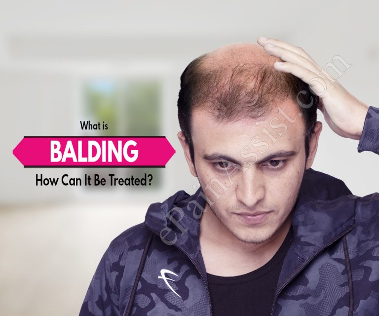 What is Balding & How Can It Be Treated?
